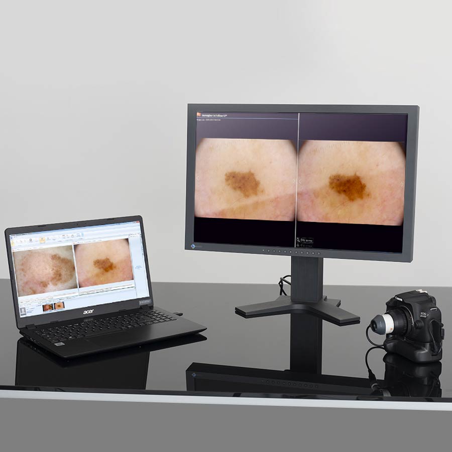 Videodermatoscopio DERMALview Portable
